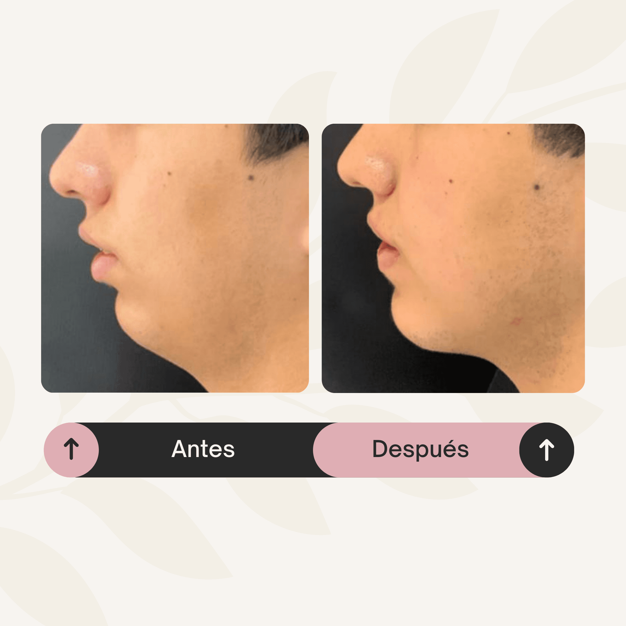Mentón: Más que una papada: armonía facial desde la estructura ósea.